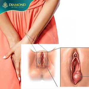 Nguyên nhân âm đạo bị rộng
